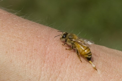 First aid for bites and stings: Part 1