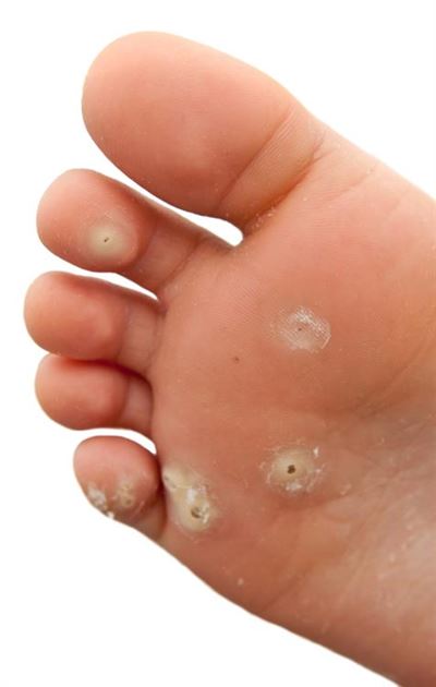 What's with warts?