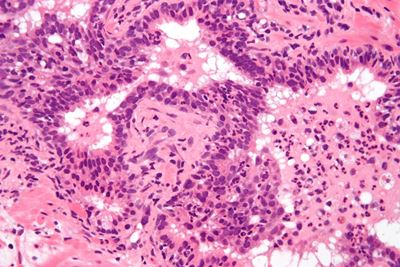 What is acute prostatitis?