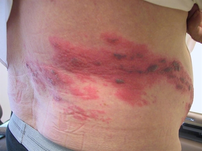 What is shingles?