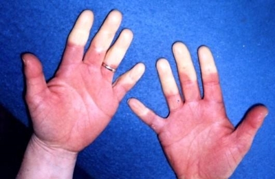What is Raynaud's phenomenon?
