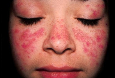 What is systemic lupus erythematosus?
