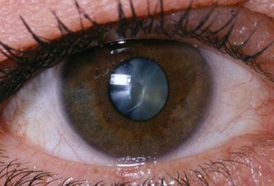 What is a cataract?