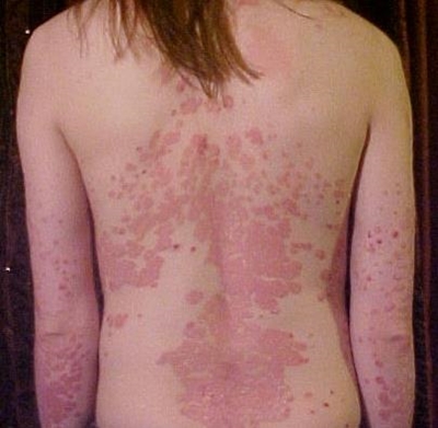 Psoriasis can affect anyone