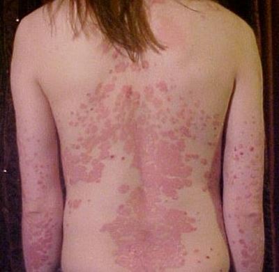 Psoriasis can affect anyone