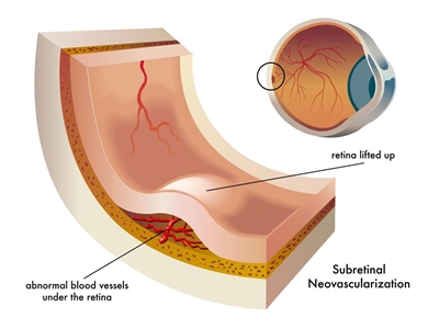 What is age-related macular degeneration?