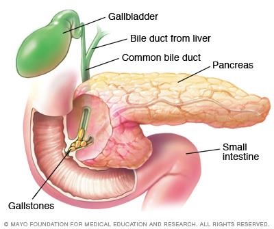 Gallstones - reduce your risk