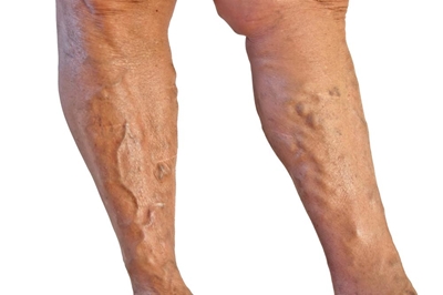 What are varicose veins?