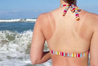 How to treat sunburn
