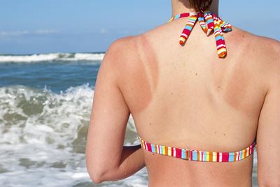 How to treat sunburn