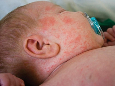 Rubella: What you need to know