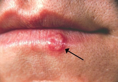 What is herpes simplex?