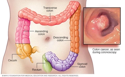 Colon cancer: early detection essential