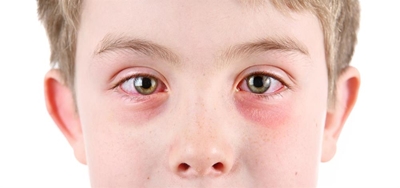 What is allergic conjunctivitis?