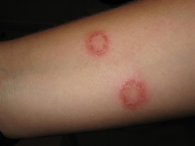 What is ringworm (dermatophytosis)?