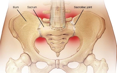Sacroiliitis difficult to diagnose