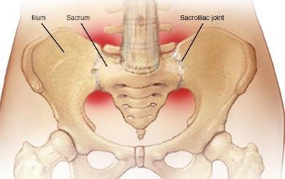 Sacroiliitis difficult to diagnose