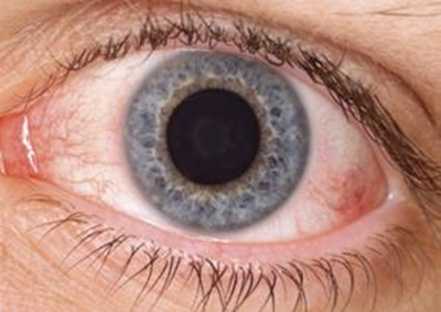 Dry eye syndrome