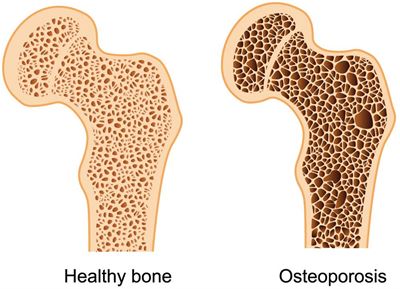 Love your bones