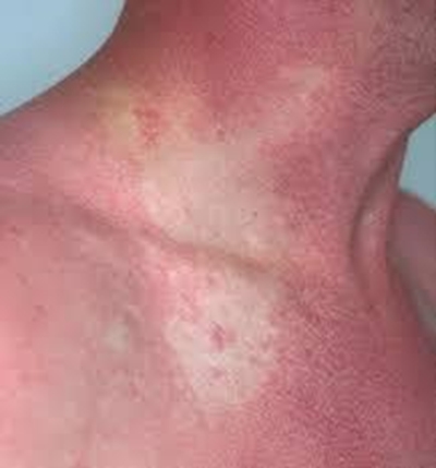Cause of scombroid poisoning