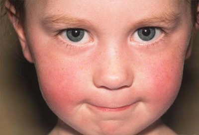 What is Fifths disease?