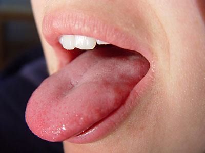 Sjögren's syndrome