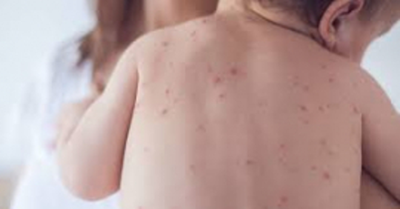 3 cases of measles outbreak confirmed in Limpopo