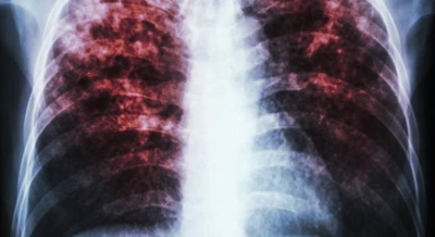 'Game changer' tuberculosis drug cures 8 in 10 