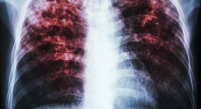 'Game changer' tuberculosis drug cures 8 in 10 