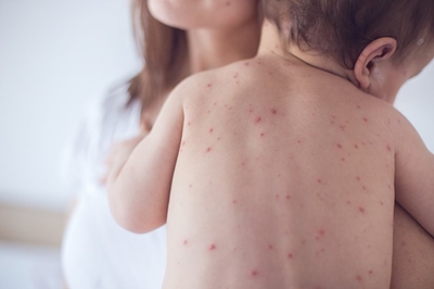 Fears for infants in Samoa as measles deaths mount