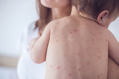 Fears for infants in Samoa as measles deaths mount
