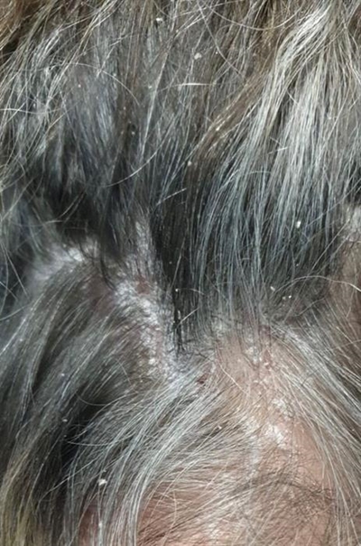 The lowdown on psoriasis