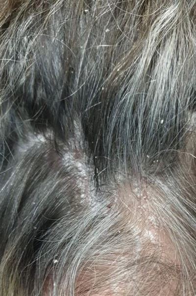 The lowdown on psoriasis