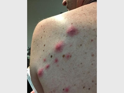 Man warns of Mango fly infestation in humans