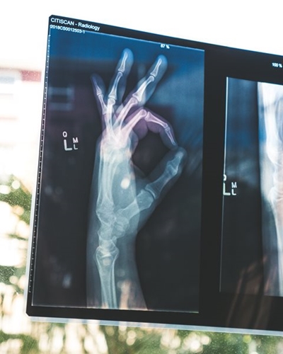 The age you hit puberty could impact bone strength later in life