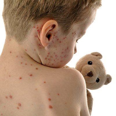 NICD declares measles outbreak in Western Cape 