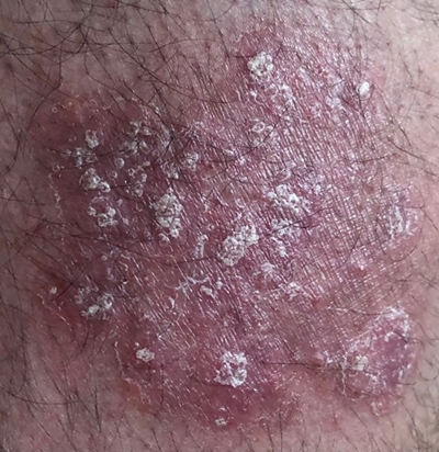 Psoriasis is not contagious, what you need to know