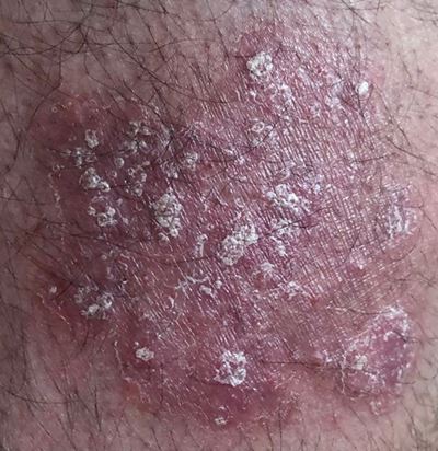 Psoriasis is not contagious, what you need to know