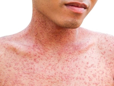 Global measles cases triple year-on-year: WHO 