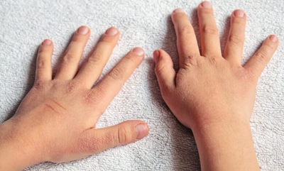 Treat your child’s dry skin in winter