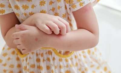 How to treat your child’s skin rash