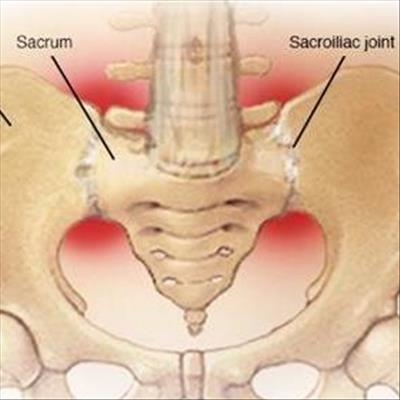 Sacroiliitis difficult to diagnose 
