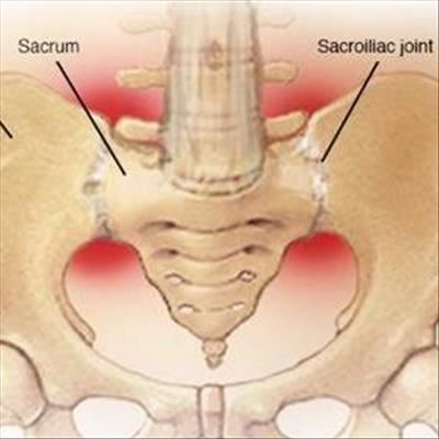 Sacroiliitis difficult to diagnose 
