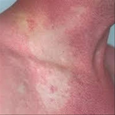 Cause of scombroid poisoning