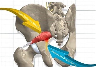 Hip pain discussed