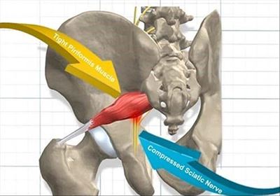 Hip pain discussed