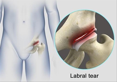 Hip pain due to labral tear