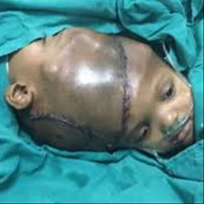 India: Separated twin 'opens eyes'