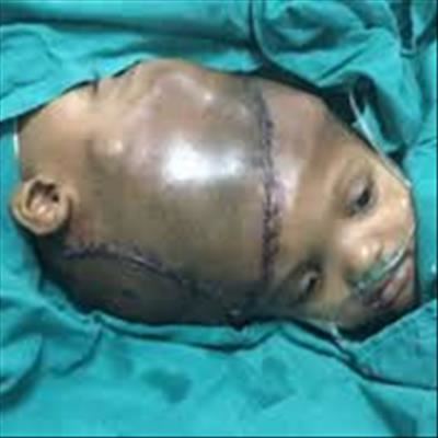 India: Separated twin 'opens eyes'