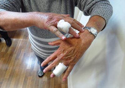 Attacker bites fingers to get rings